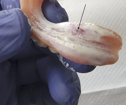 Step 3: DUAL PINPOINT ACCURACY CHECK — Remove appliance. Identify the displaced Hydent Spray. Locate the blue spot created by the Hydent Stick. Use a bur to relieve any high spots. Reinsert the appliance to guarantee patient comfort.