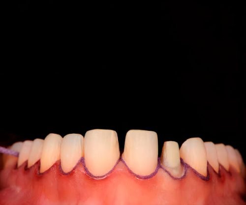 retraction-cords-tooth-2