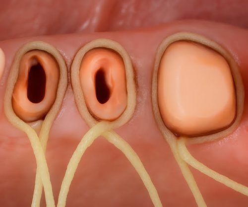 retraction-cords-tooth-5