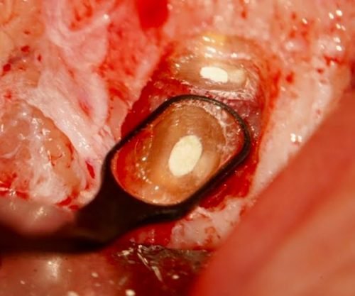 Hemostatic Pellets at Surgical Site