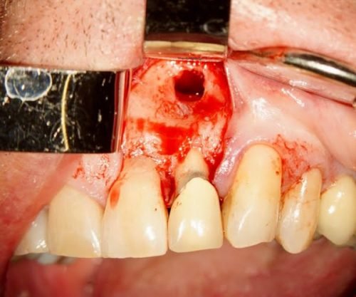 Immediate and Profound Hemostasis